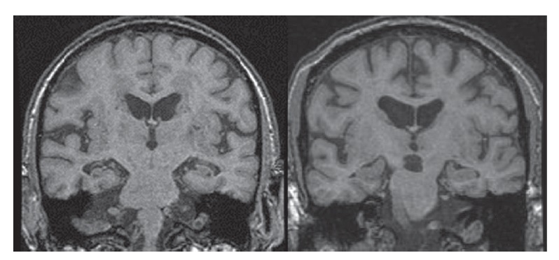 Alzheimer  Falha em estudo coloca em xeque a hipótese da placa amiloide -  Canaltech